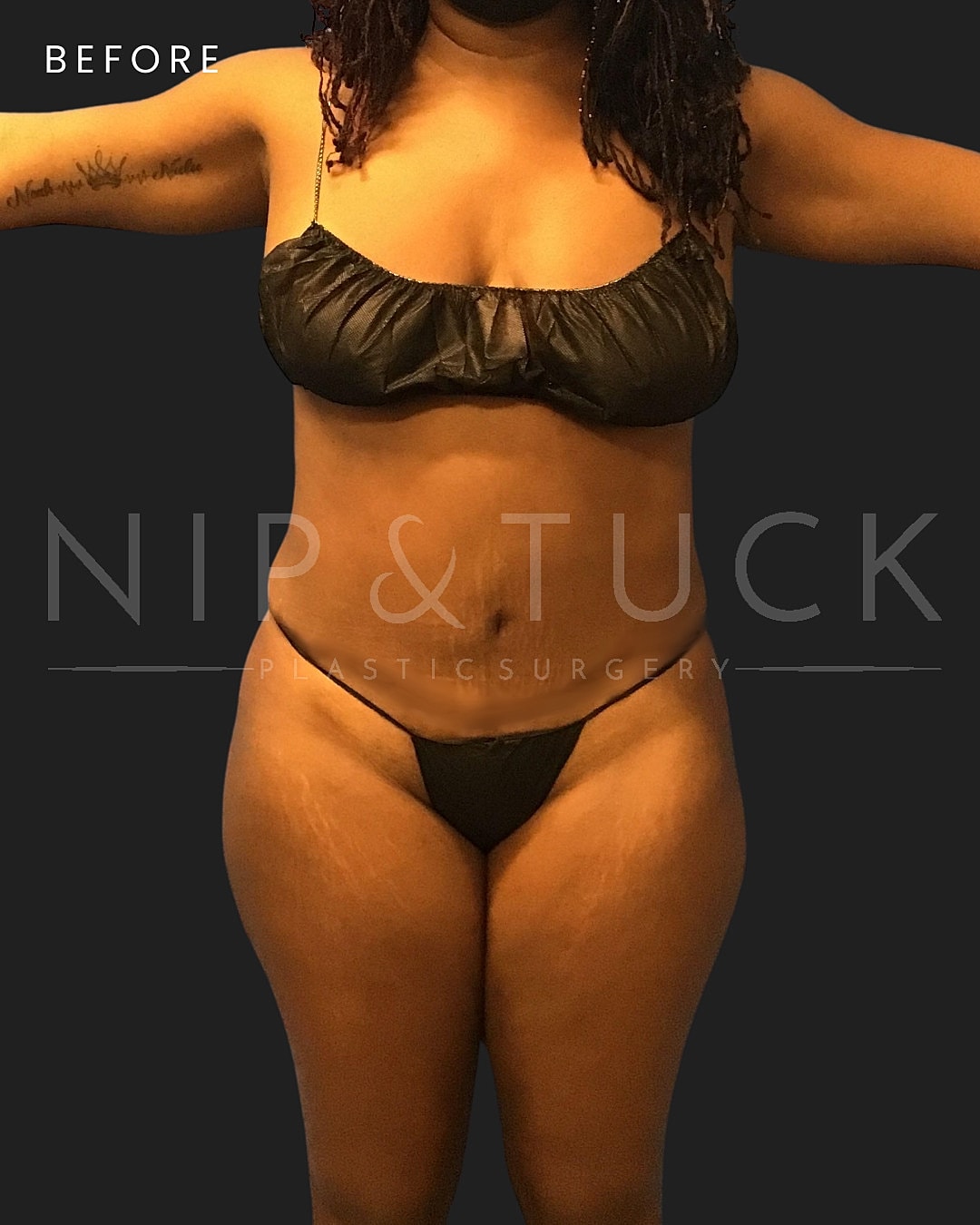 Lipo 360 Before & After