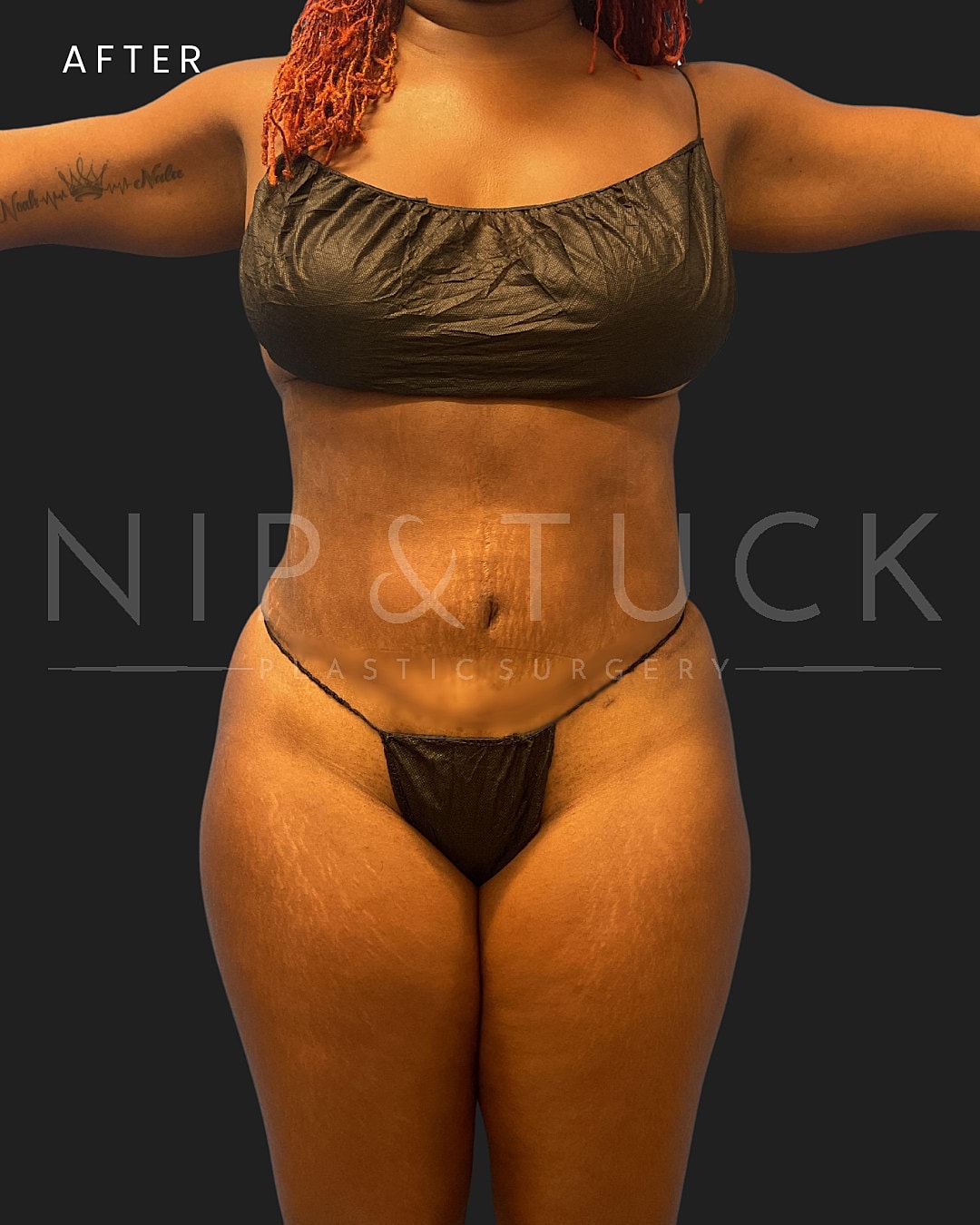 Lipo 360 Before & After