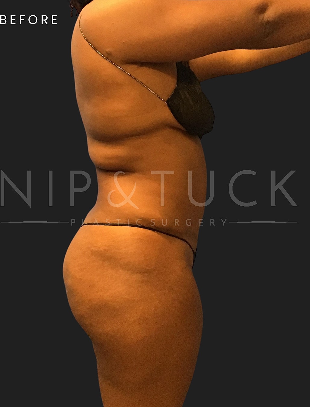 Lipo 360 Before & After