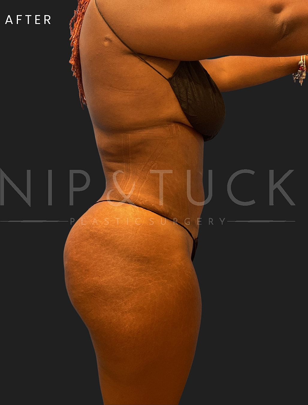 Lipo 360 Before & After