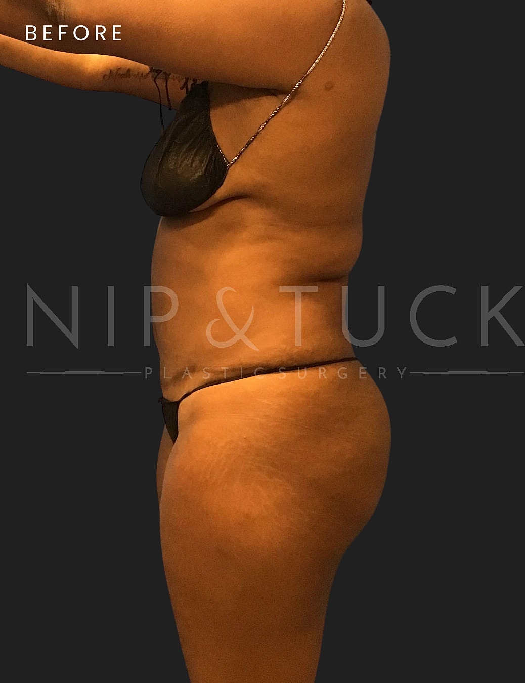 Lipo 360 Before & After