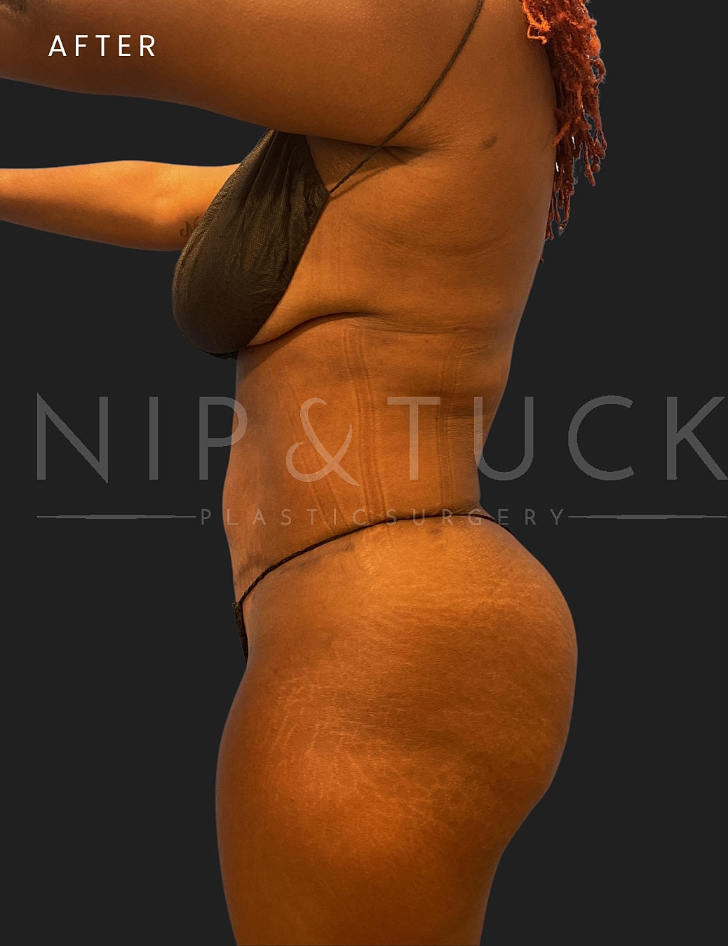Lipo 360 Before & After