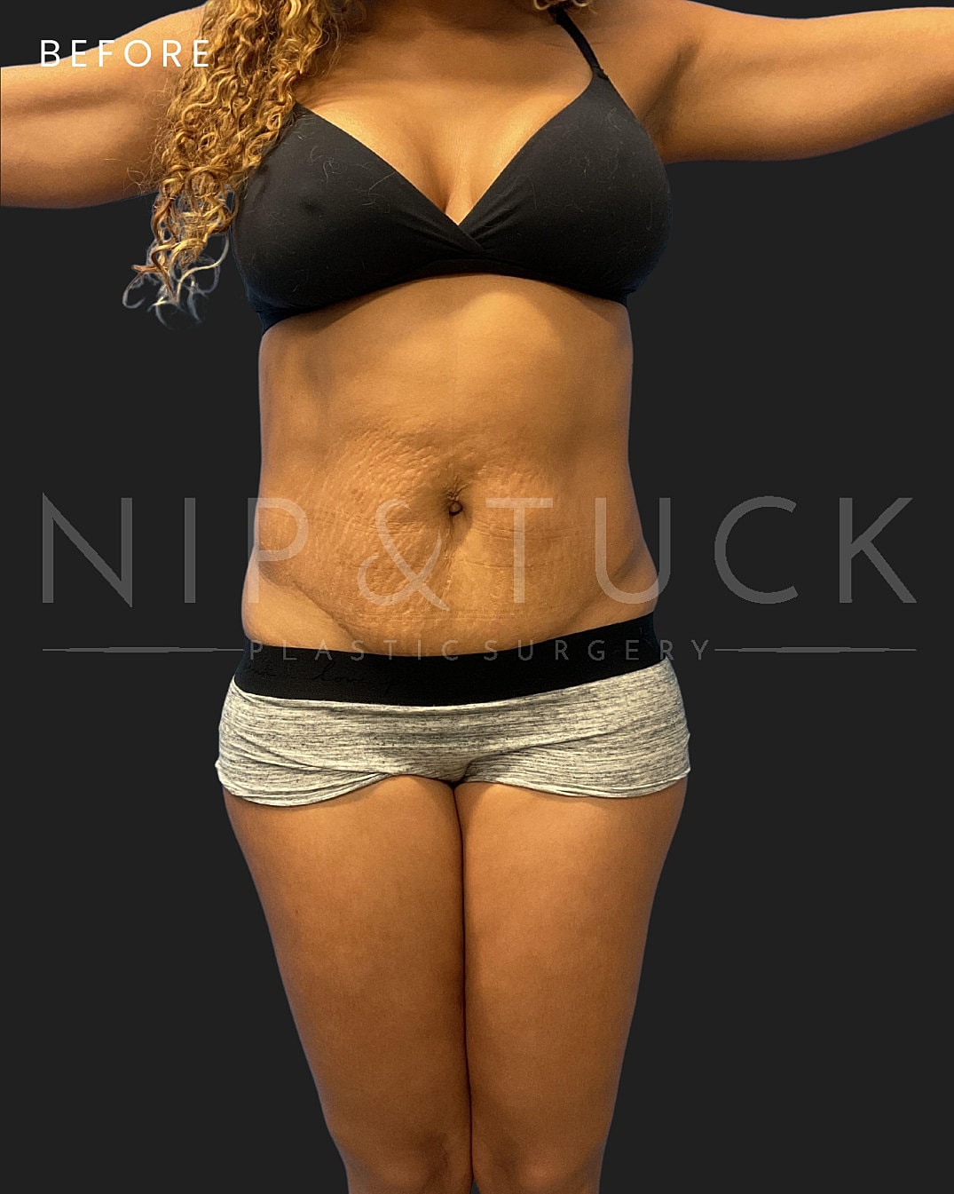 Lipo 360 Before & After