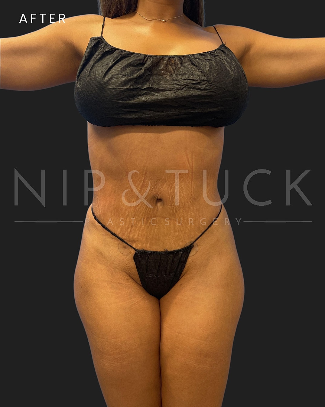 Lipo 360 Before & After