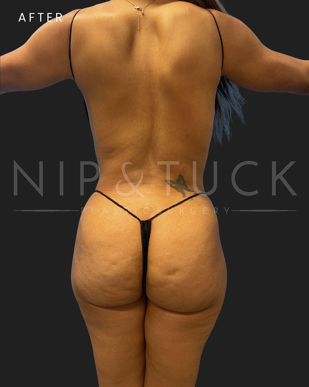 Lipo 360 Before & After