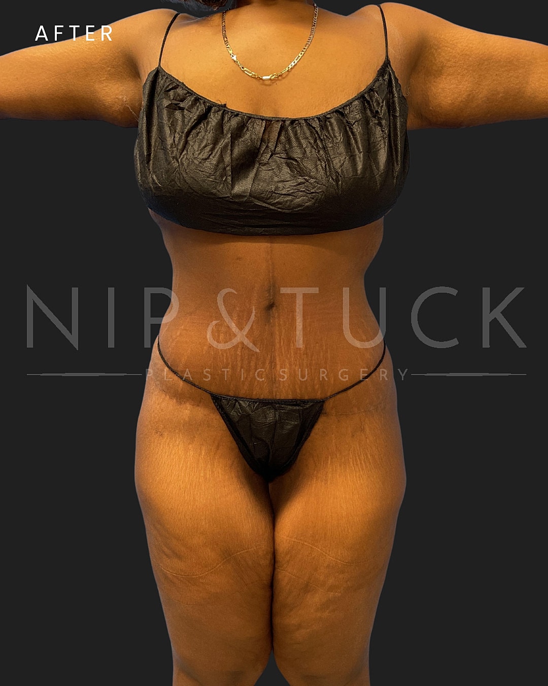Lipo 360 Before & After