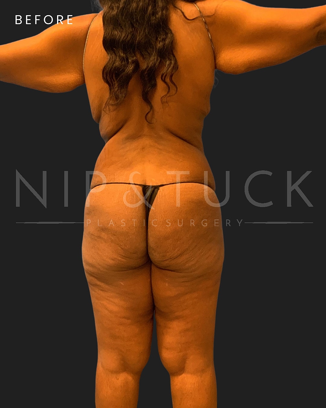 Lipo 360 Before & After