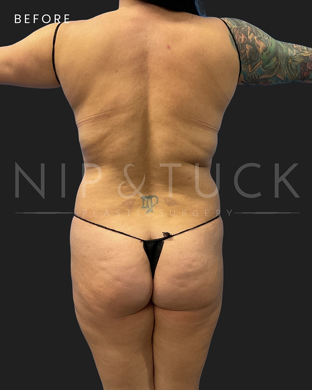Lipo 360 Before & After
