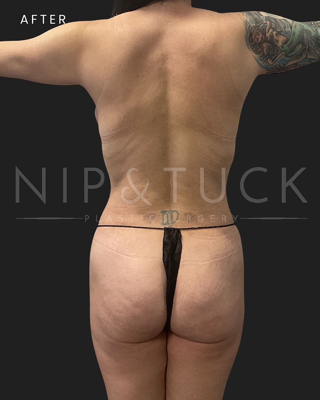Lipo 360 Before & After