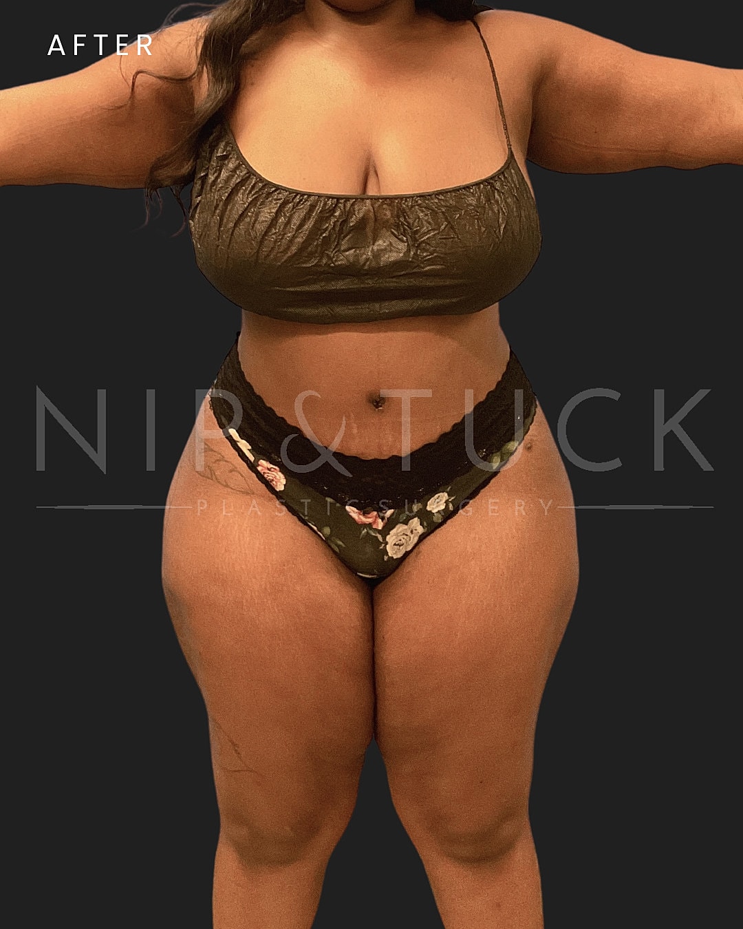 Lipo 360 Before & After
