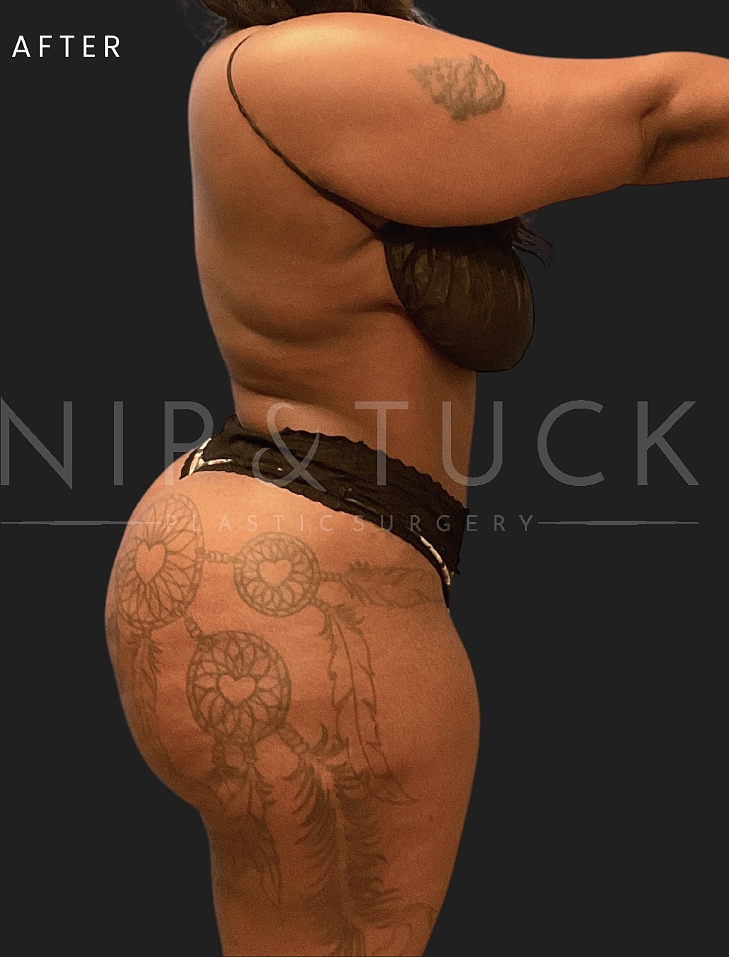 Lipo 360 Before & After