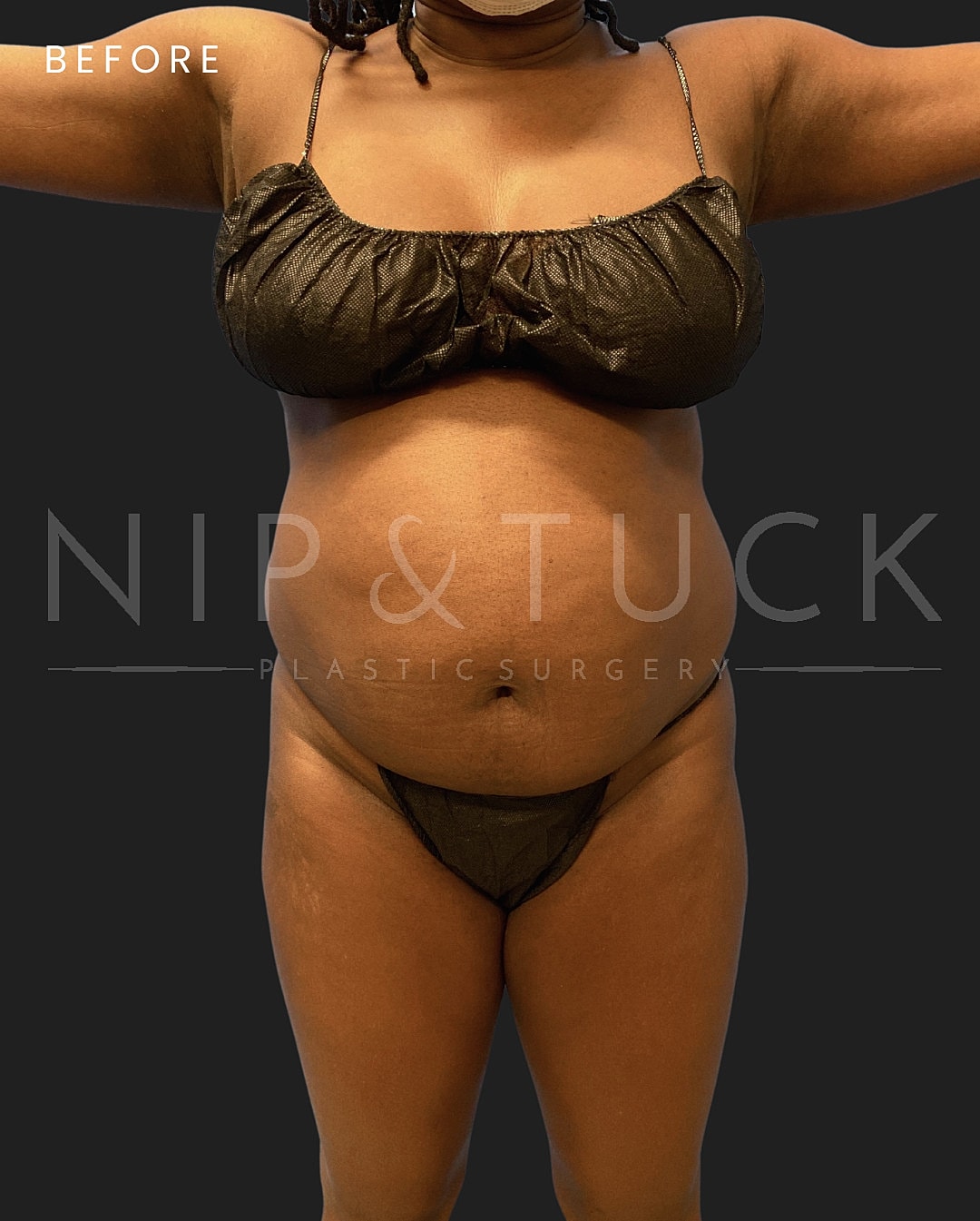 Lipo 360 Before & After