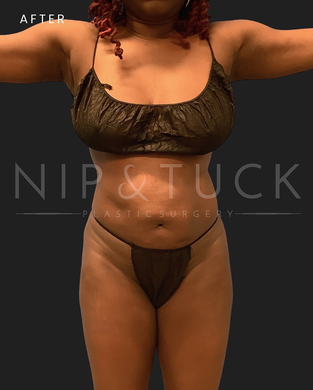 Lipo 360 Before & After