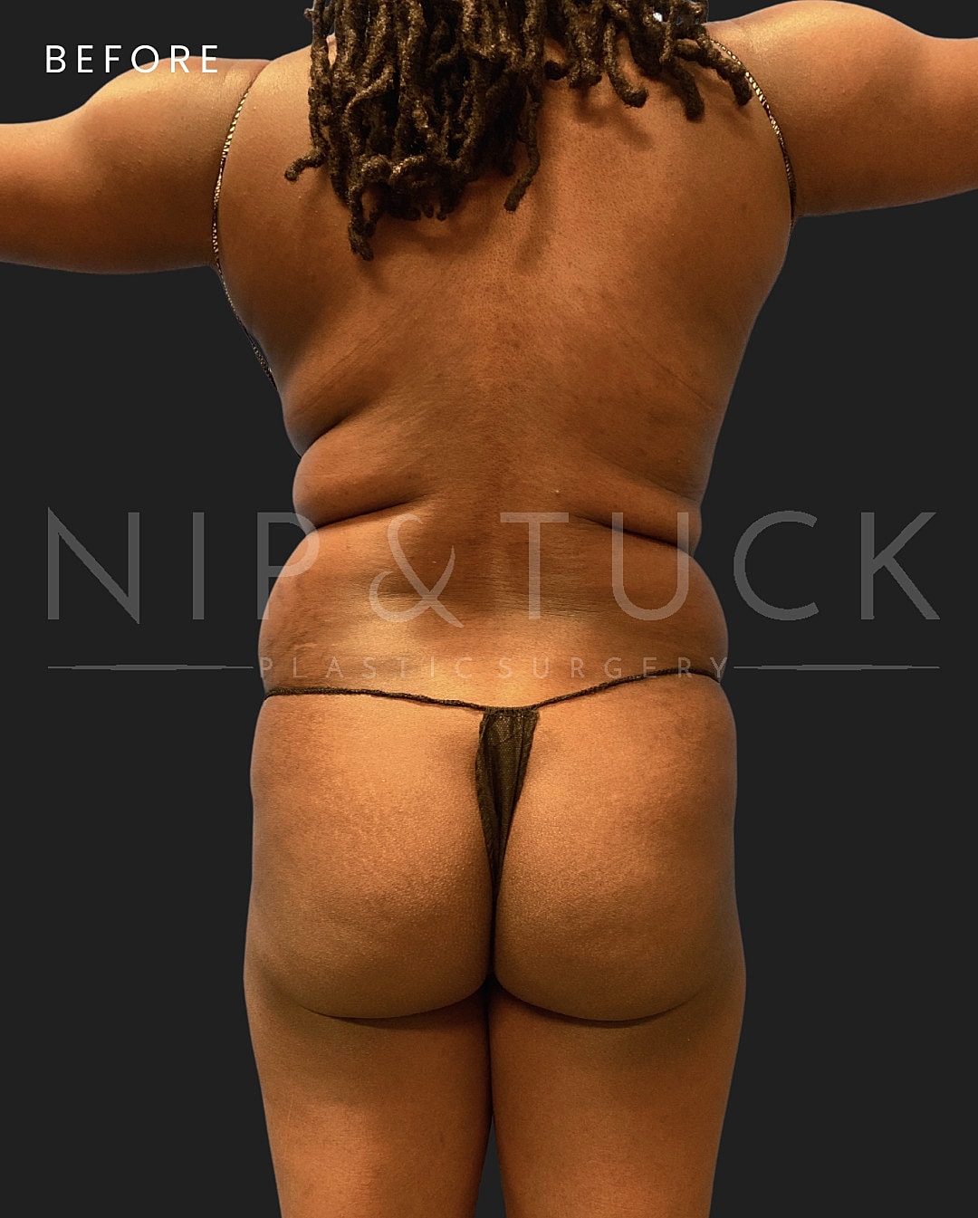 Lipo 360 Before & After