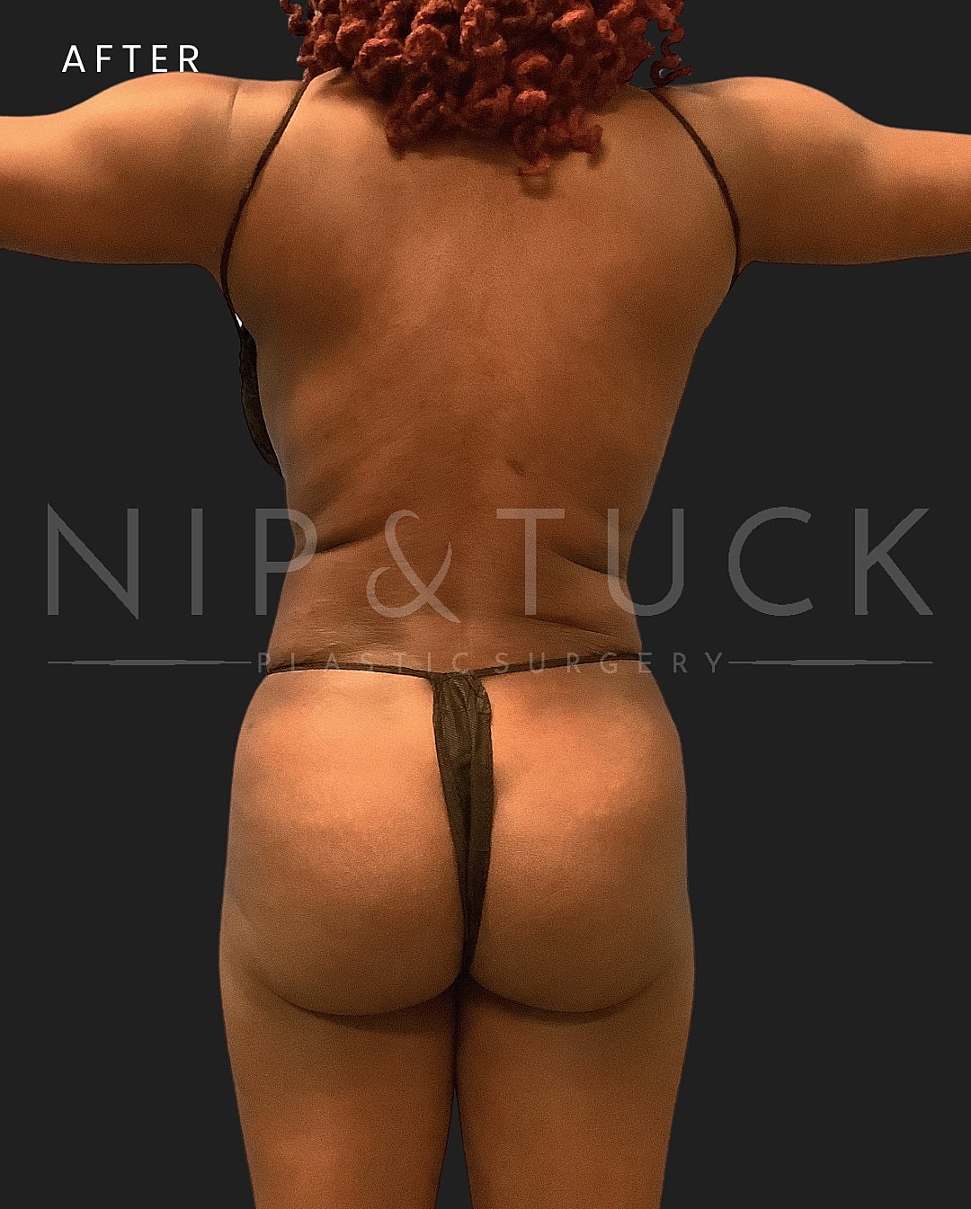 Lipo 360 Before & After