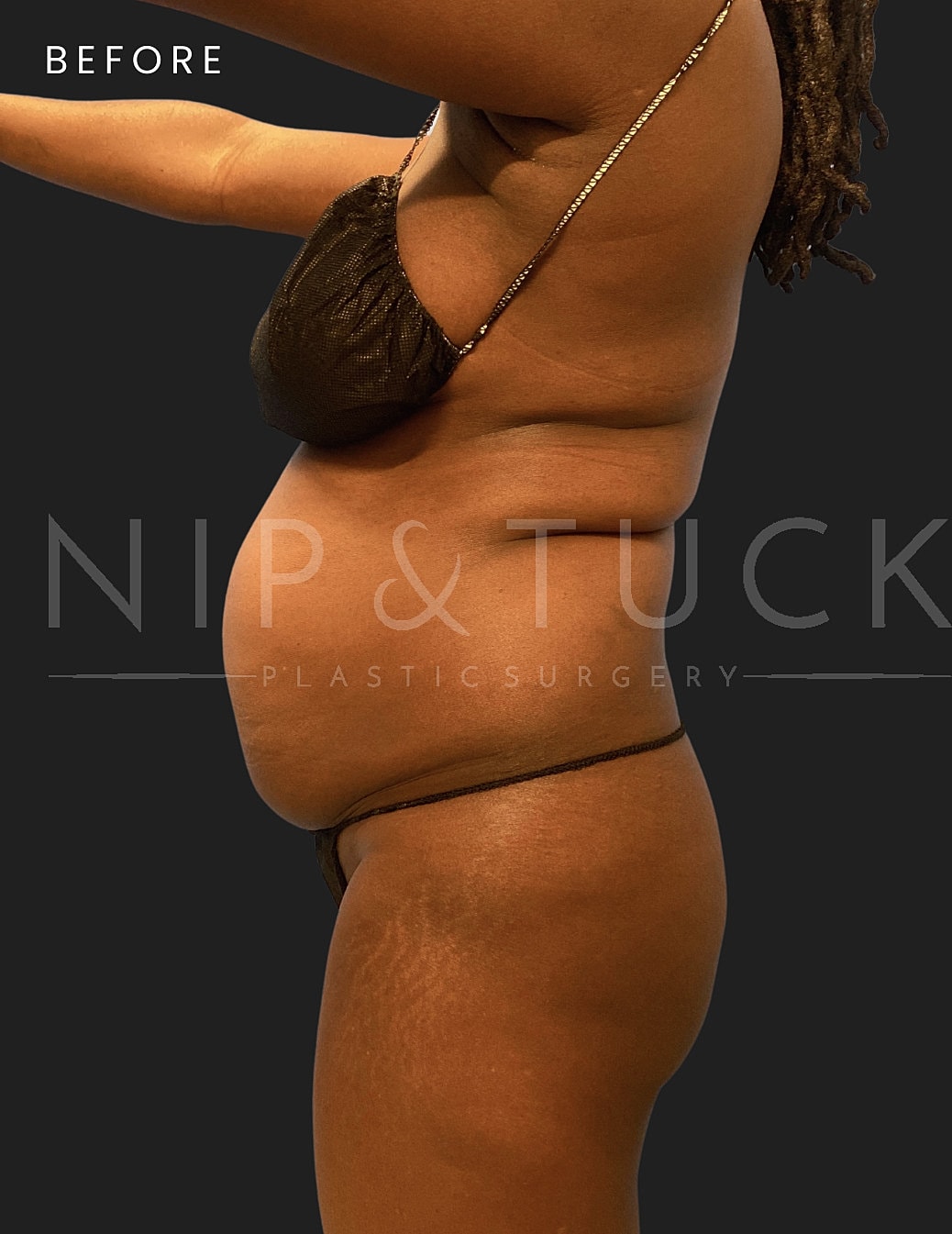 Lipo 360 Before & After