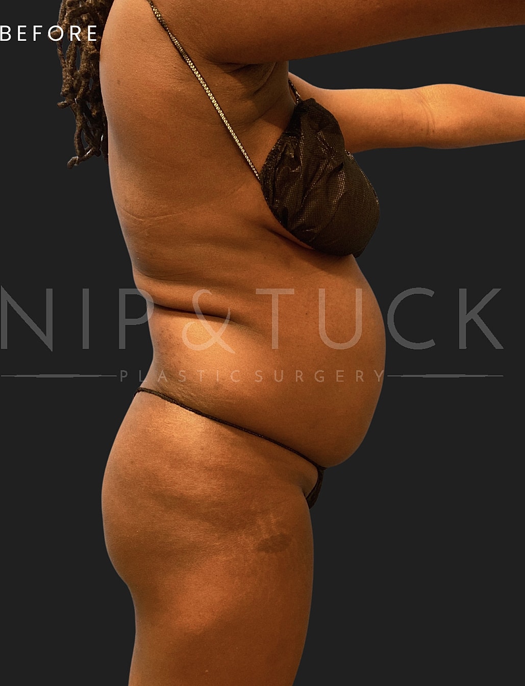Lipo 360 Before & After