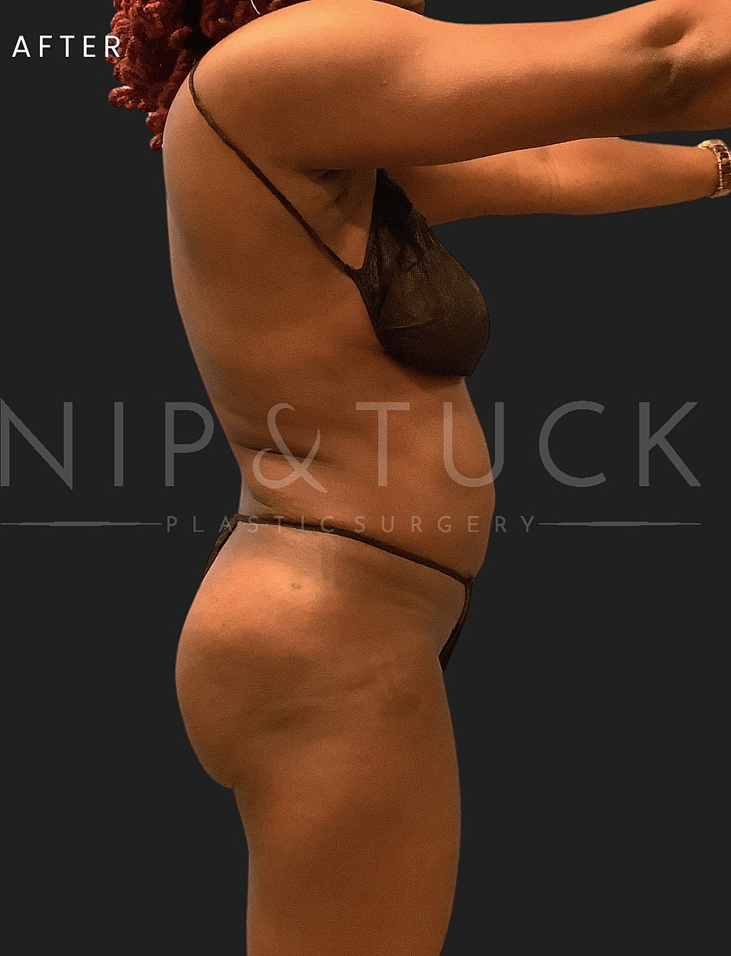 Lipo 360 Before & After