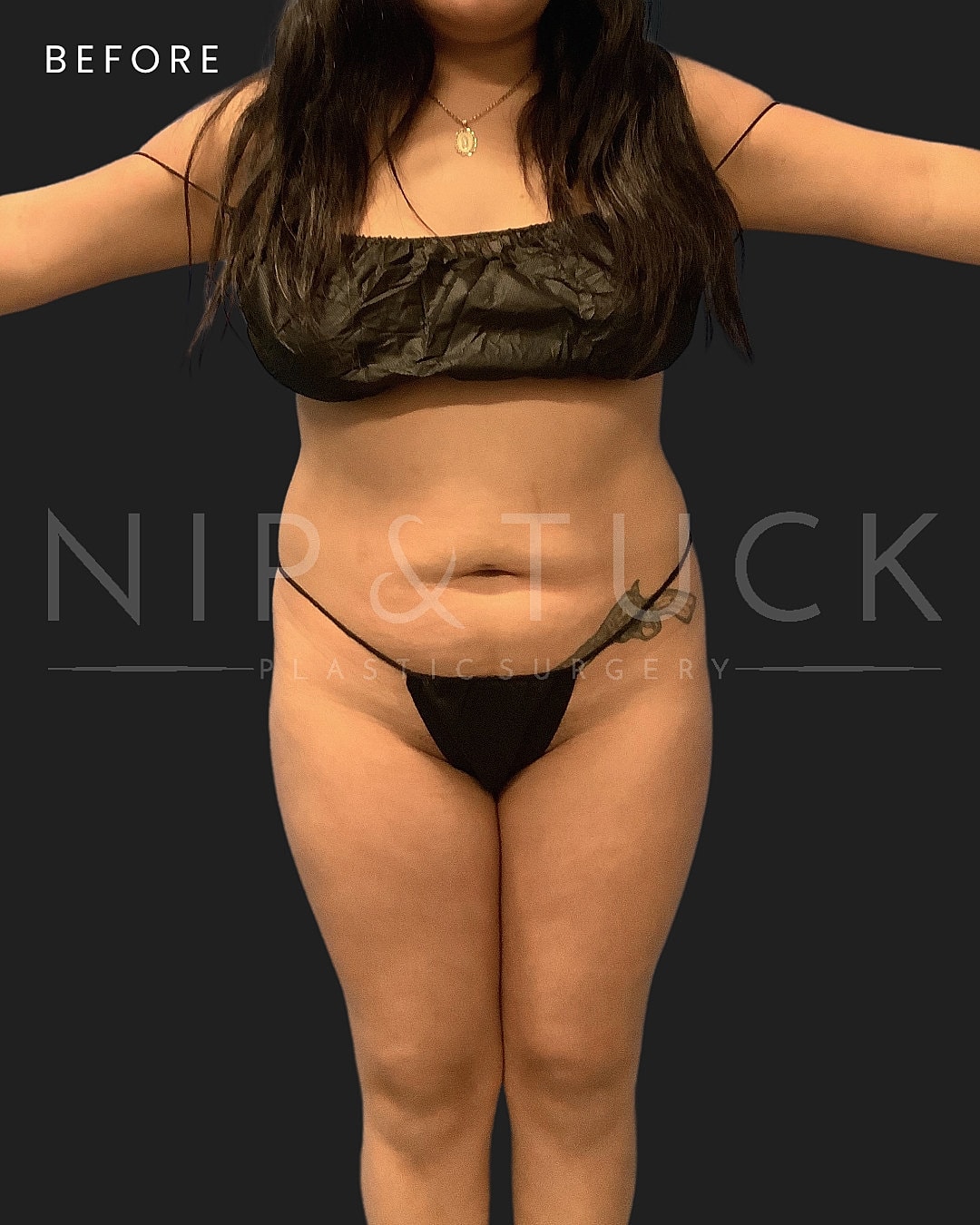 Lipo 360 Before & After