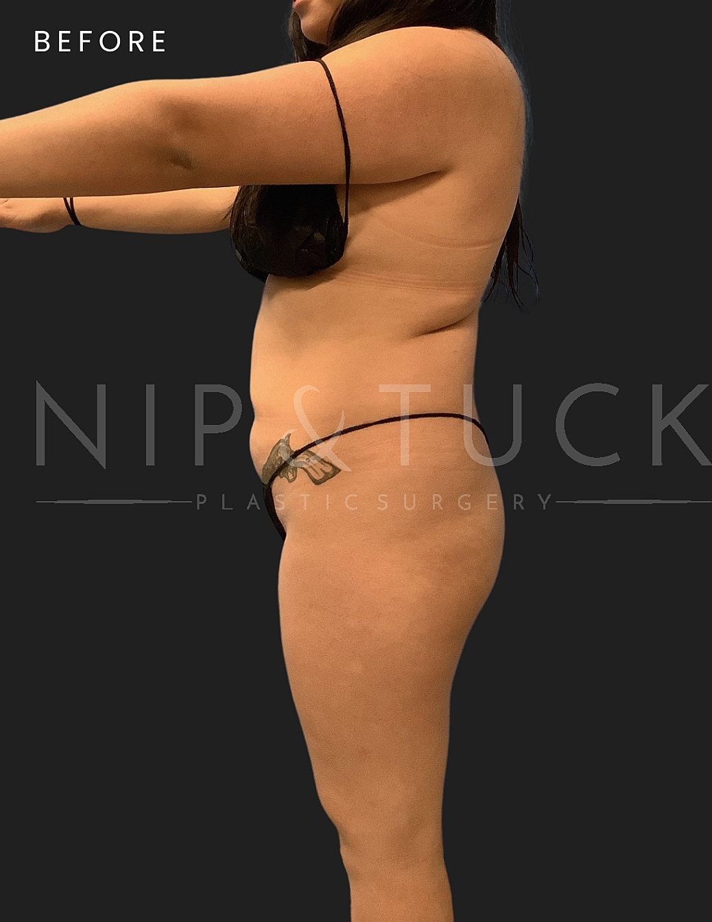 Lipo 360 Before & After