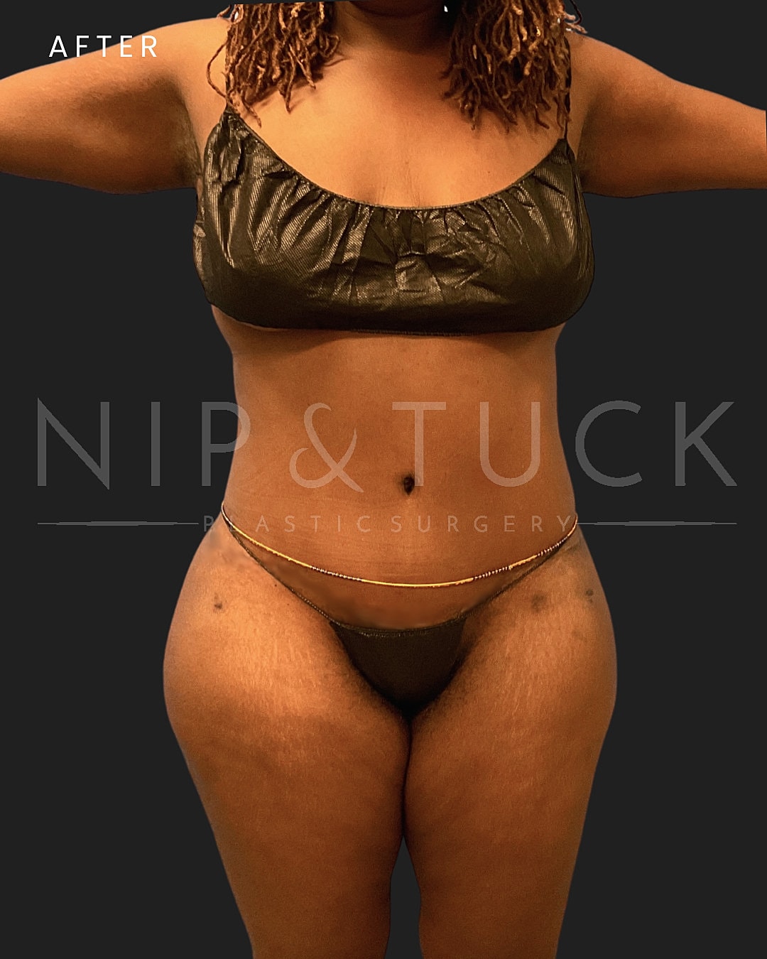 Lipo 360 Before & After