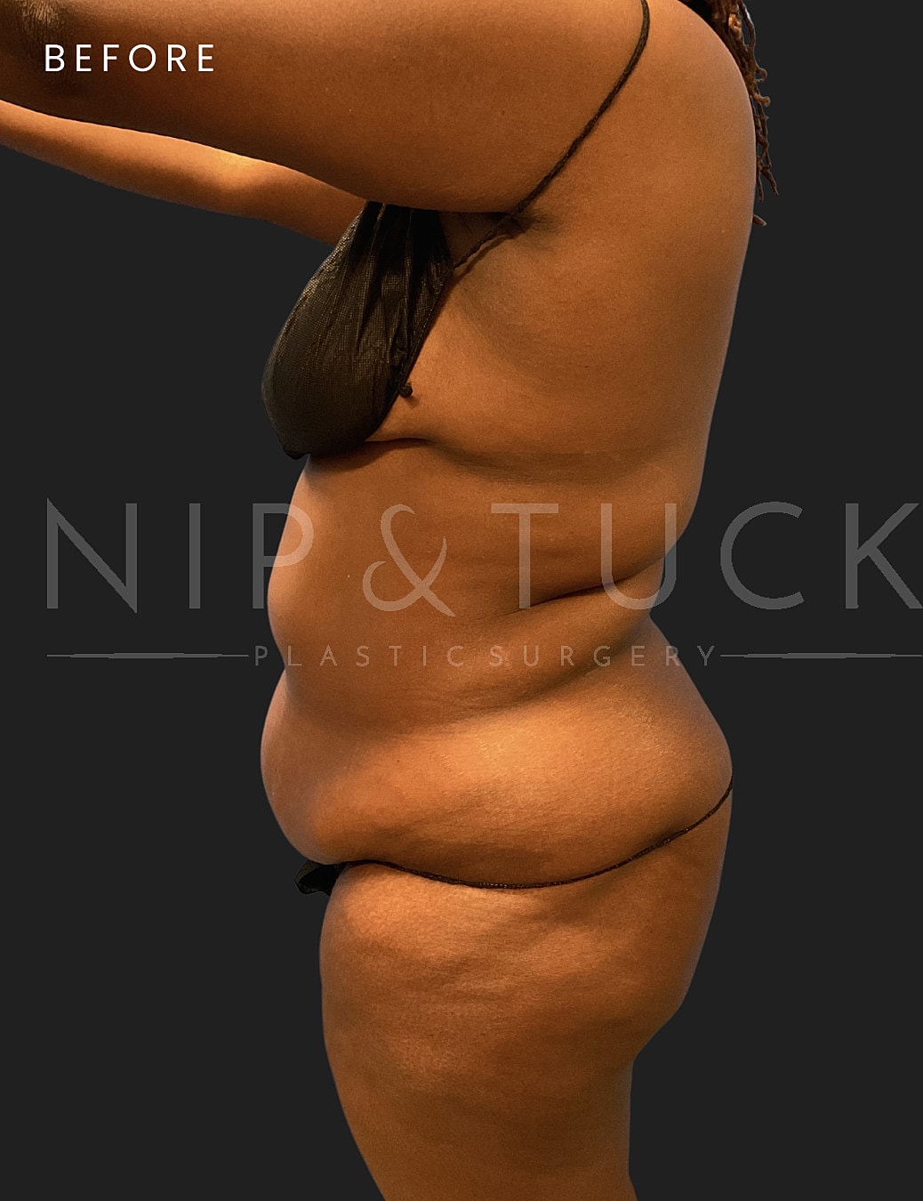 Lipo 360 Before & After