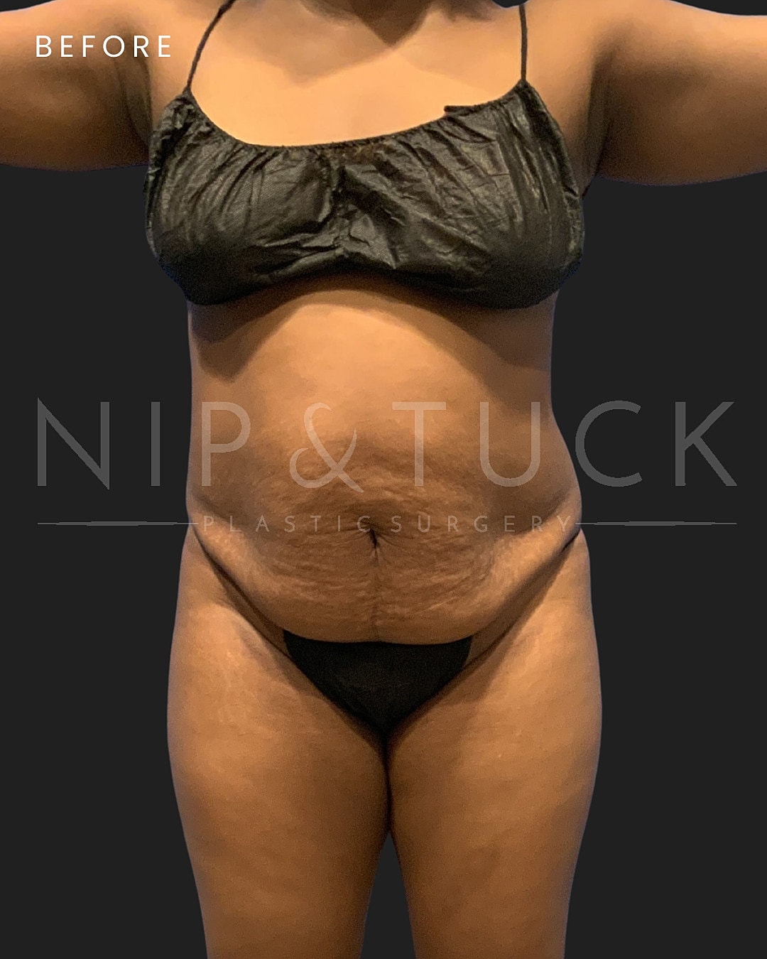 Lipo 360 Before & After