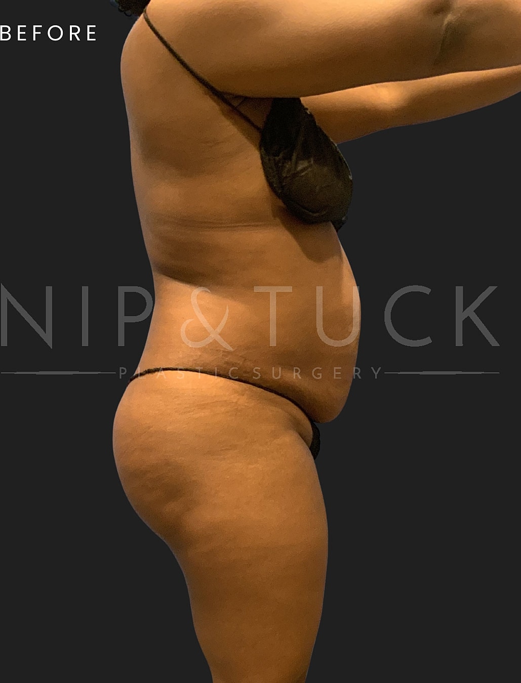 Lipo 360 Before & After