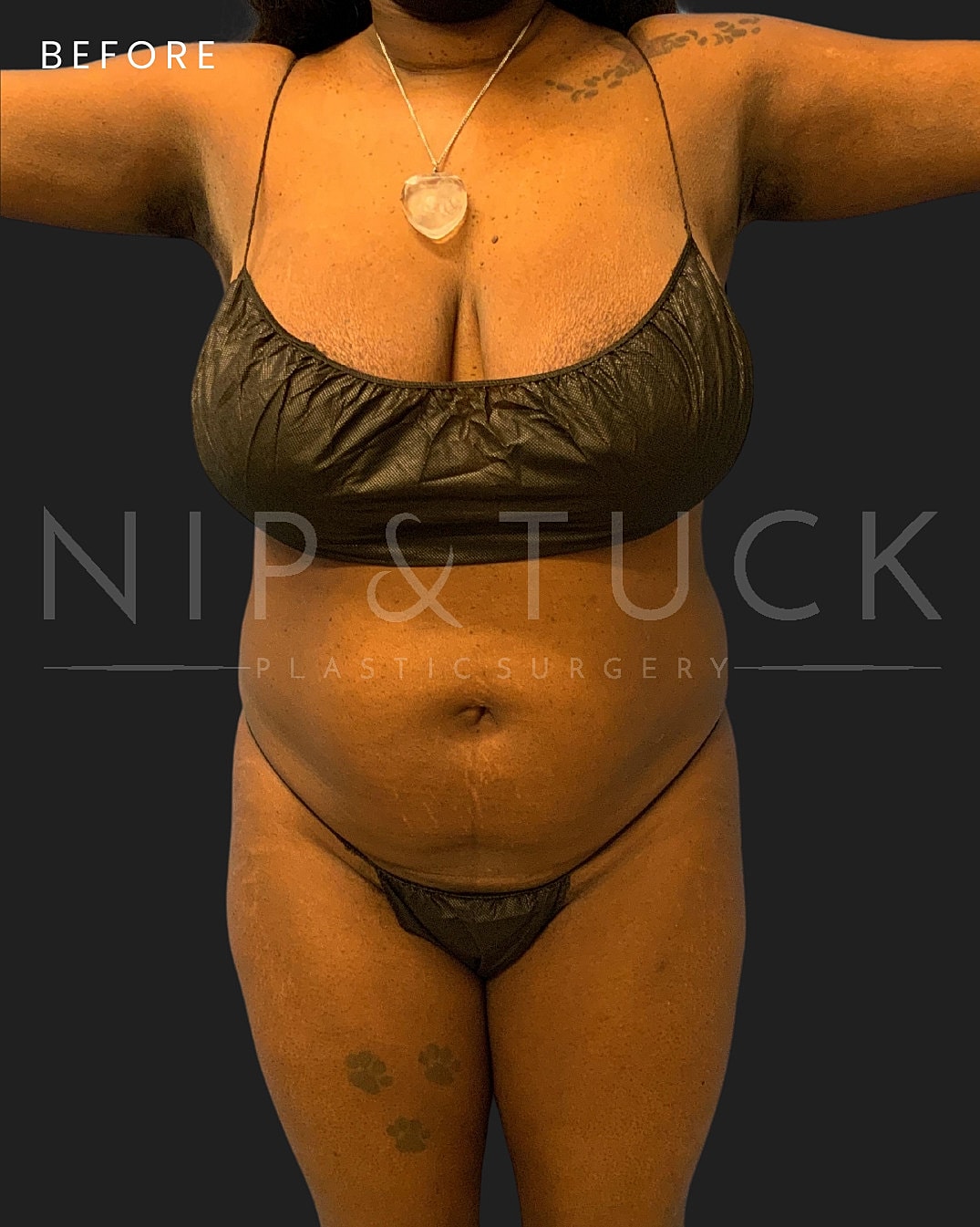 Lipo 360 Before & After