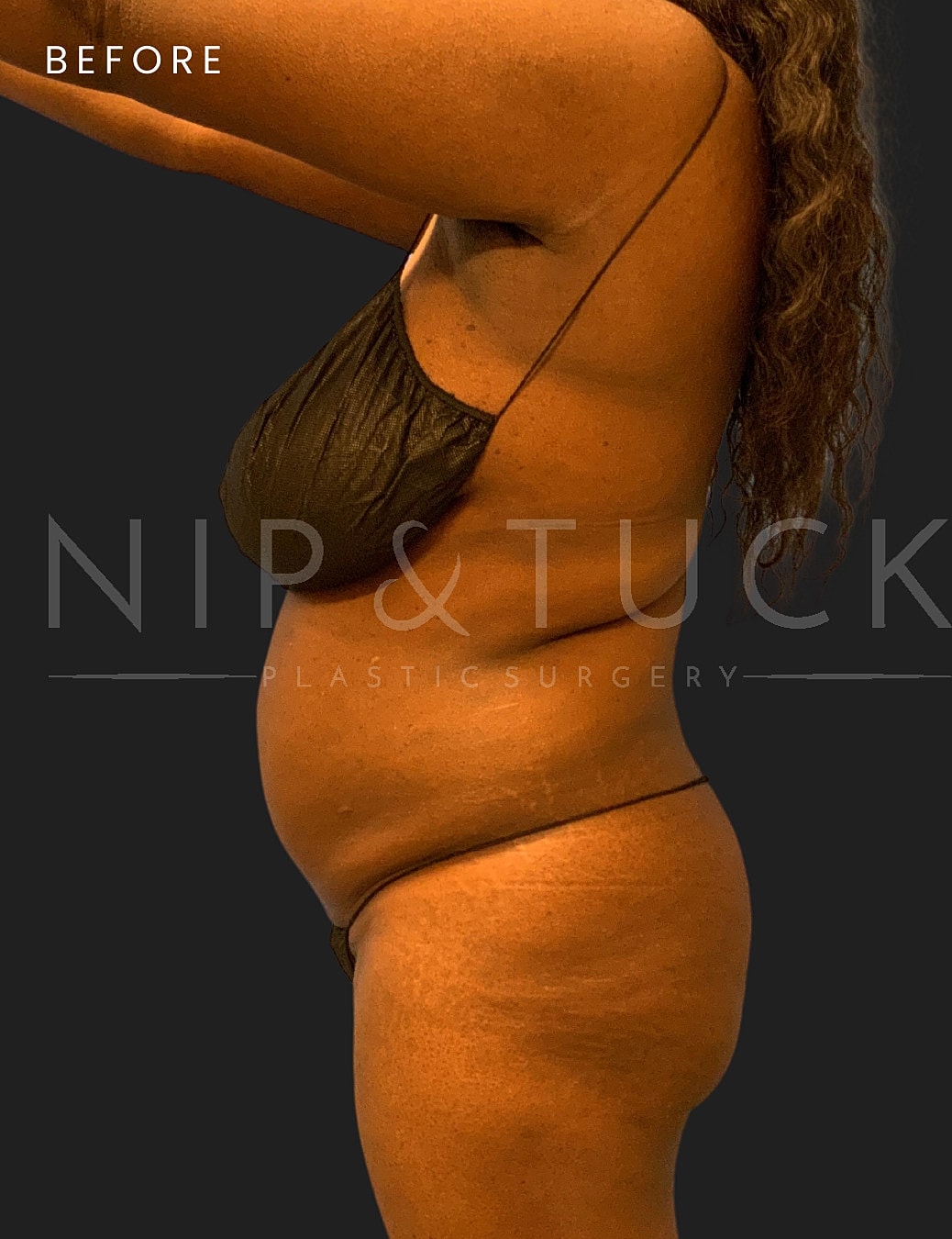 Lipo 360 Before & After