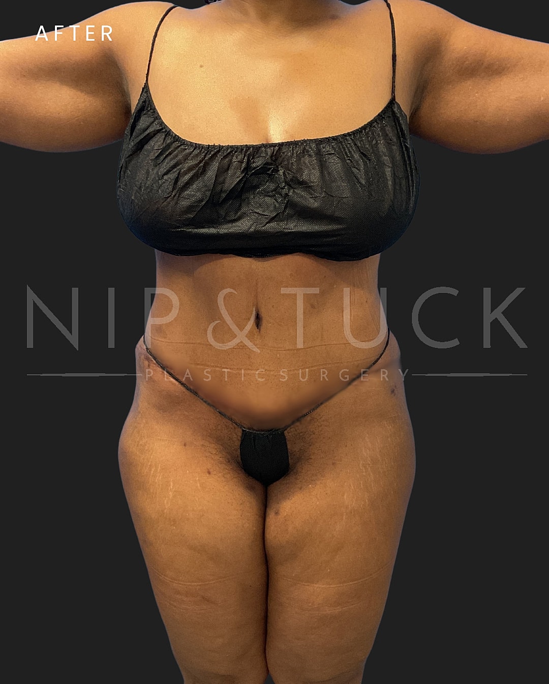 Lipo 360 Before & After