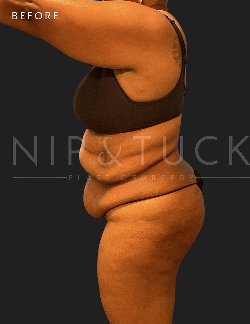 Lipo 360 Before & After