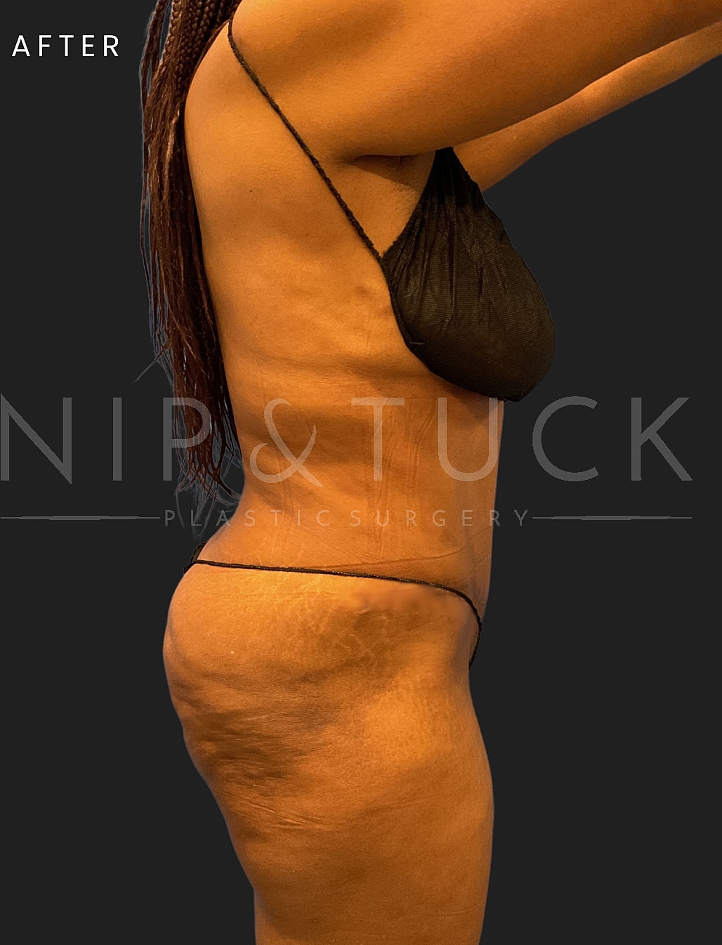 Lipo 360 Before & After