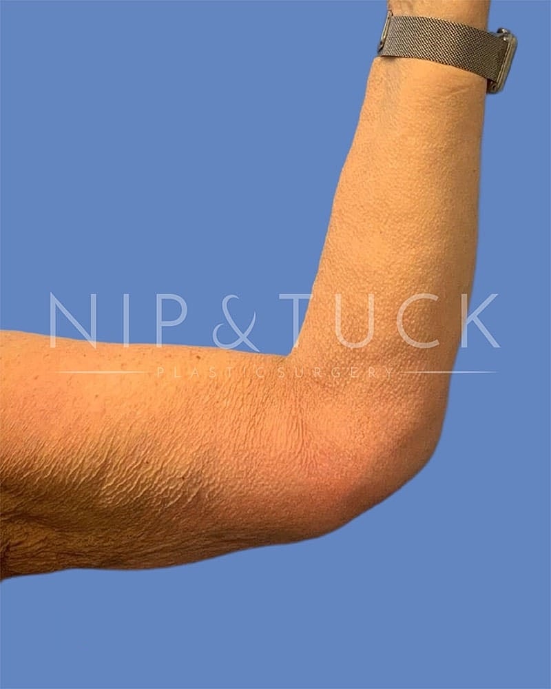 Arm Lift Before & After