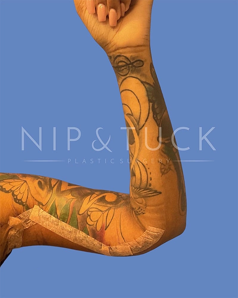 Arm Lift Before & After