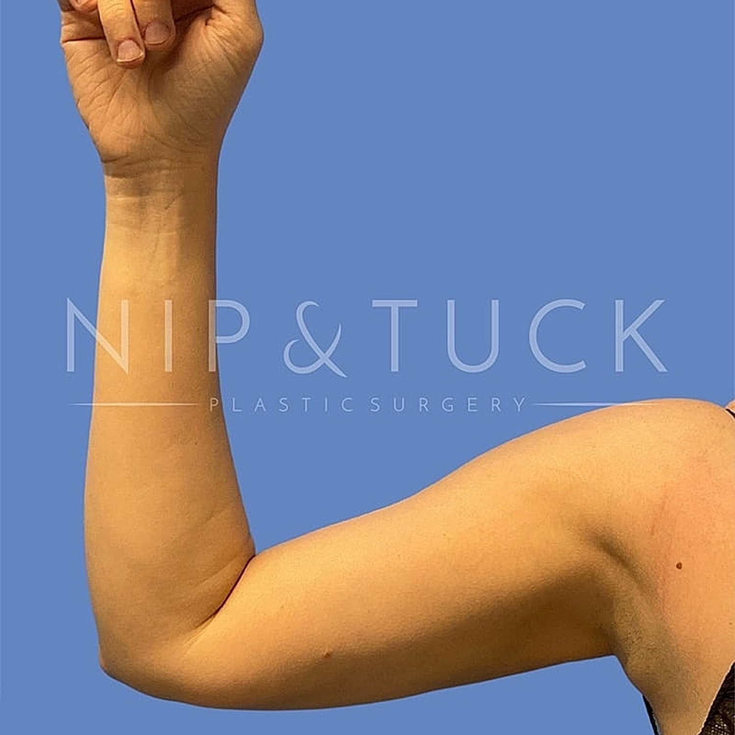 Arm flexing in a plastic surgery context.