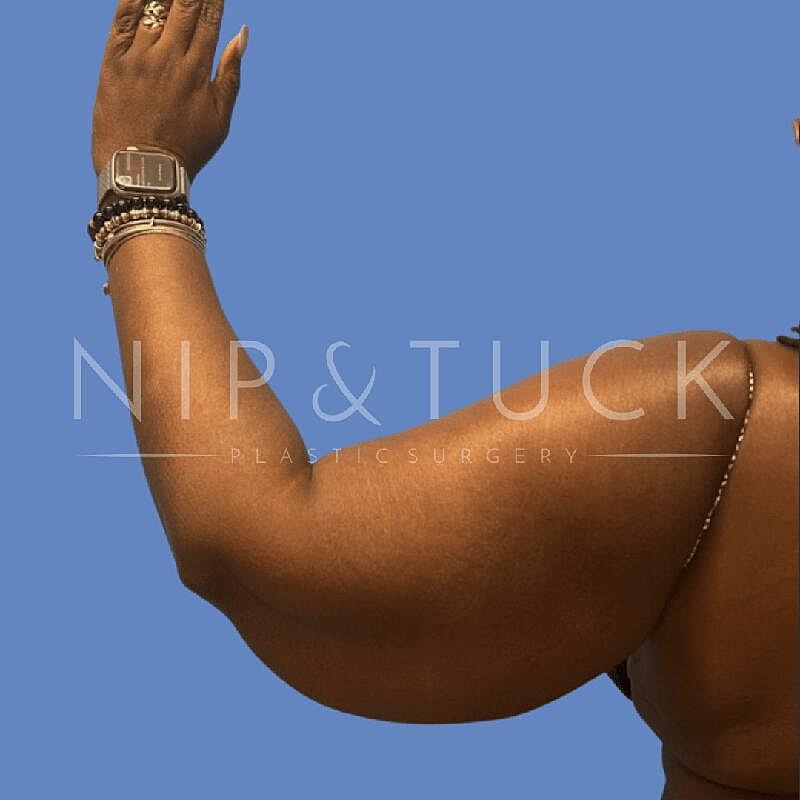 Arm Lift Before & After