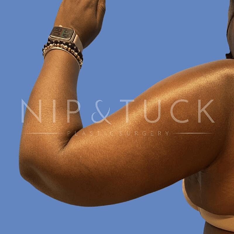 Arm Lift Before & After