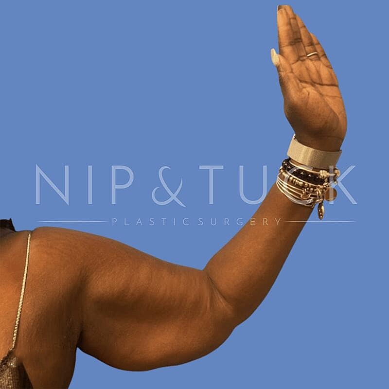 Arm Lift Before & After