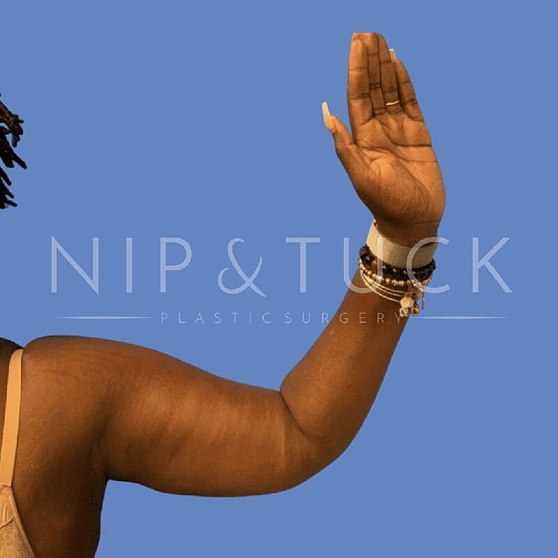 Arm Lift Before & After