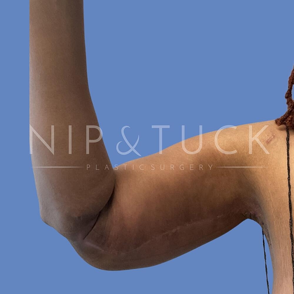 Arm Lift Before & After