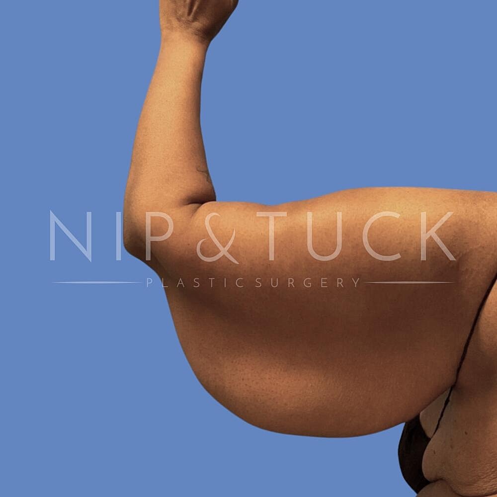 Arm Lift Before & After