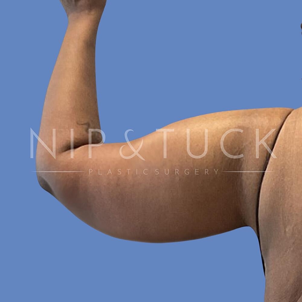 Arm Lift Before & After