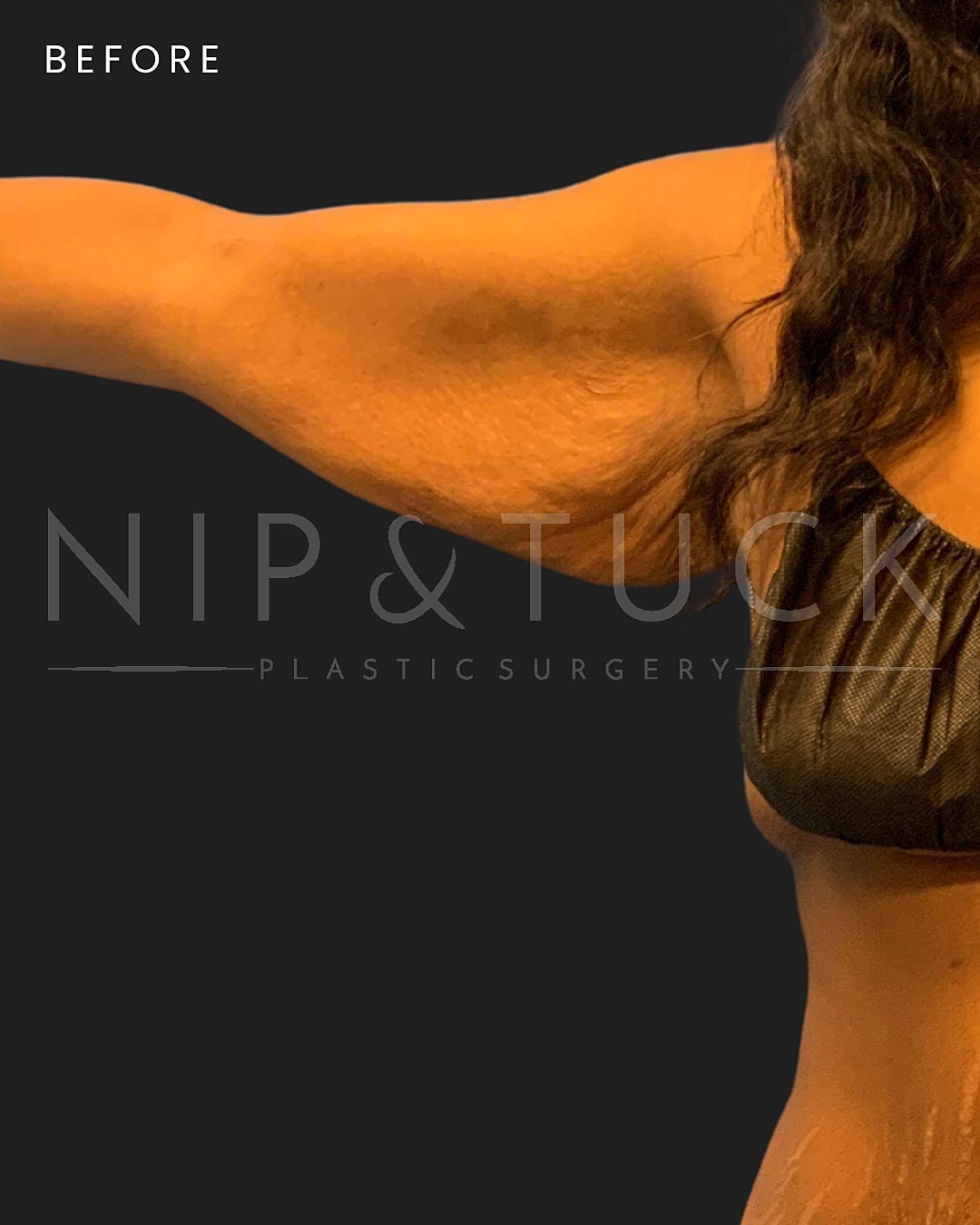 Arm Lift Before & After