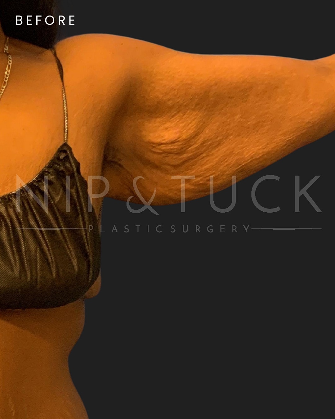 Arm Lift Before & After