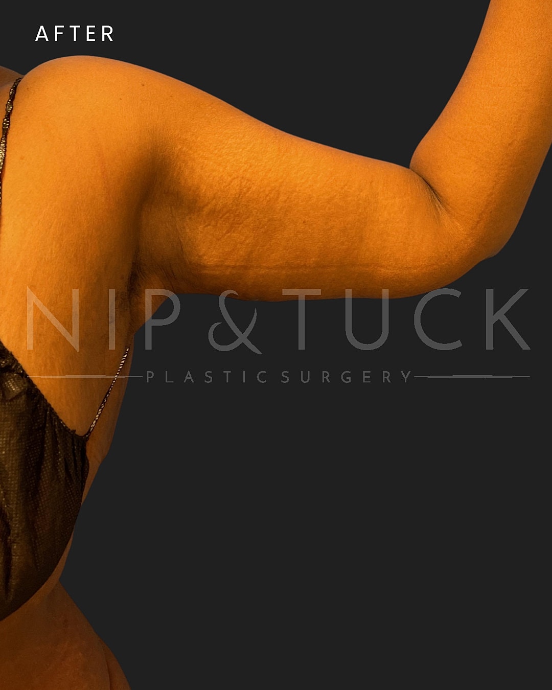 Arm Lift Before & After