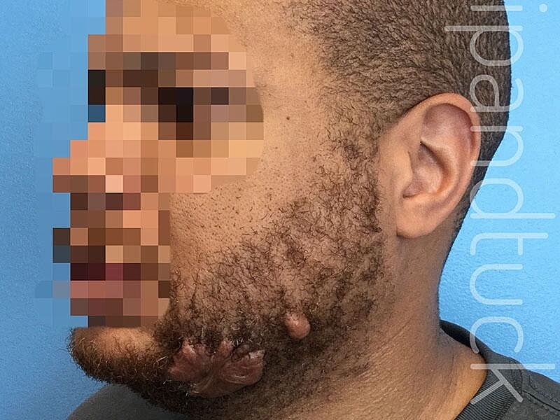 Scar Revision Before & After