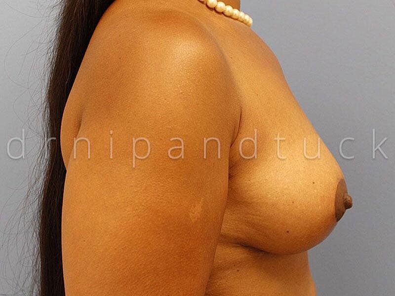 Mastopexy With Fat Grafting Before & After