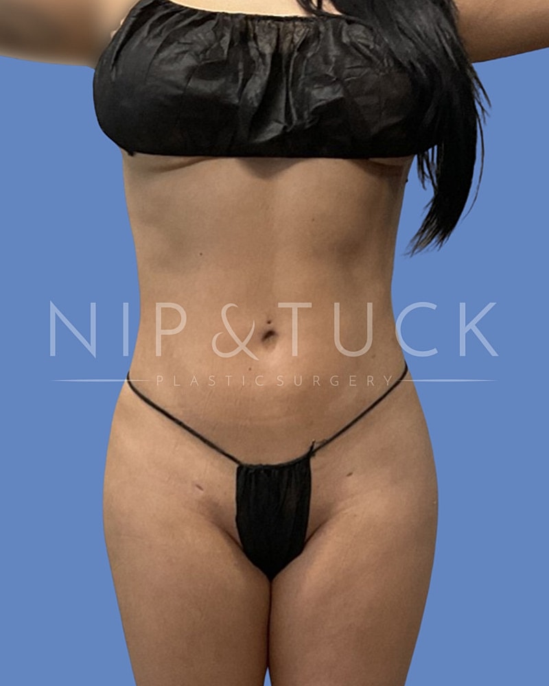 Liposuction Before & After