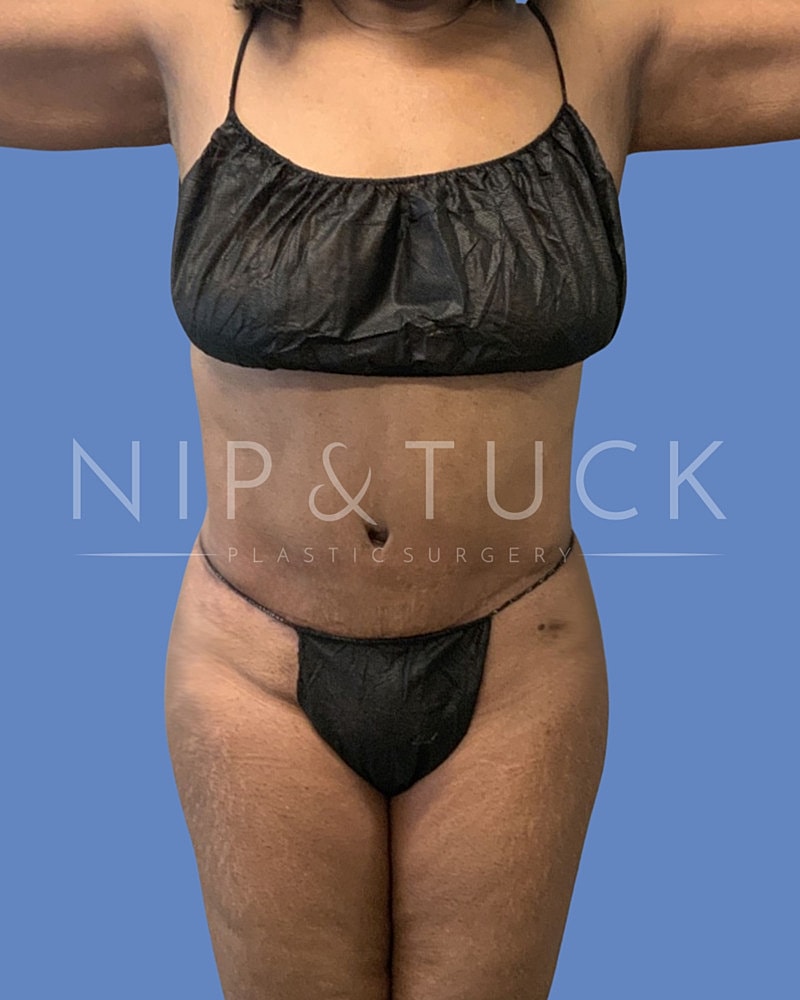 Liposuction Before & After